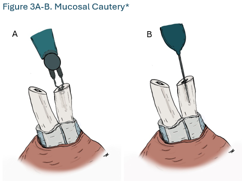 Figure 3A-B. Mucosal Cautery * Figure 3A-B. Mucosal Cautery *