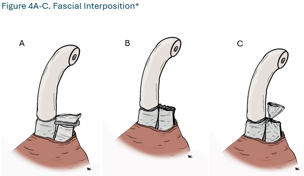 Figure 4A-C. Fascial Interposition* Figure 4A-C. Fascial Interposition*