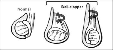 Figure 1. Bell clapper deformity. Normal testis lie is on the left and the classic 