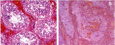 Figure 2. Testis histology during early
A) hemorrhagic phase and chronic late (B) phases of testis torsion. Note the decreased seminiferous tubule diameter and loss of germ cells in late relative to early phases.