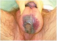 Figure 6. Fournier's gangrene of the scrotum.
