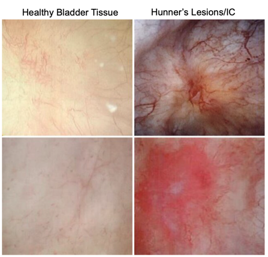 Figure 1: Healthy Bladder Tissue and Hunner Lesions