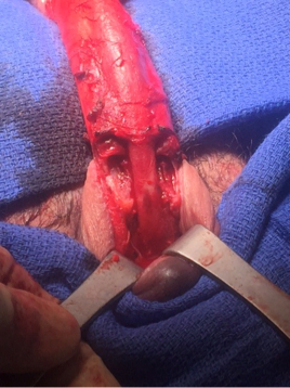 Figure 9: Intraoperative photograph of a penile fracture with concurrent urethral injury. This was repaired via a penoscrotal incision.