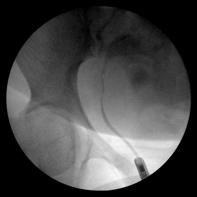 Figure 12: Retrograde pyelogram demonstrating contrast extravasation from iatrogenic ureteral injury.
