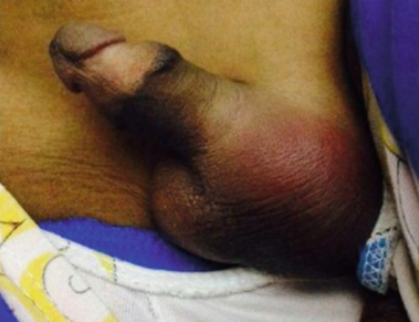 Figure 3. Example of acute scrotum highlighting hallmark signs of testicular torsion, including color change and swelling (from Al-Salem AH: Acute Scrotum. In: Atlas of Pediatric Surgery. Springer, Cham. (2020)).
