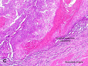 what is squamous cell carcinoma
