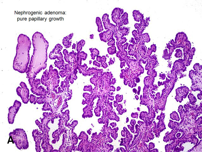 nephrogenic adenoma pathology outlines)