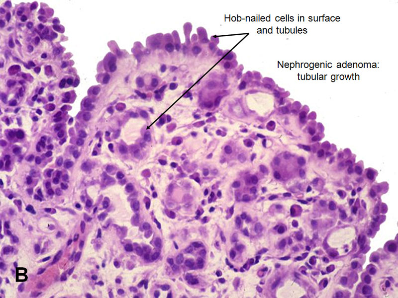 nephrogenic adenoma pathology outlines