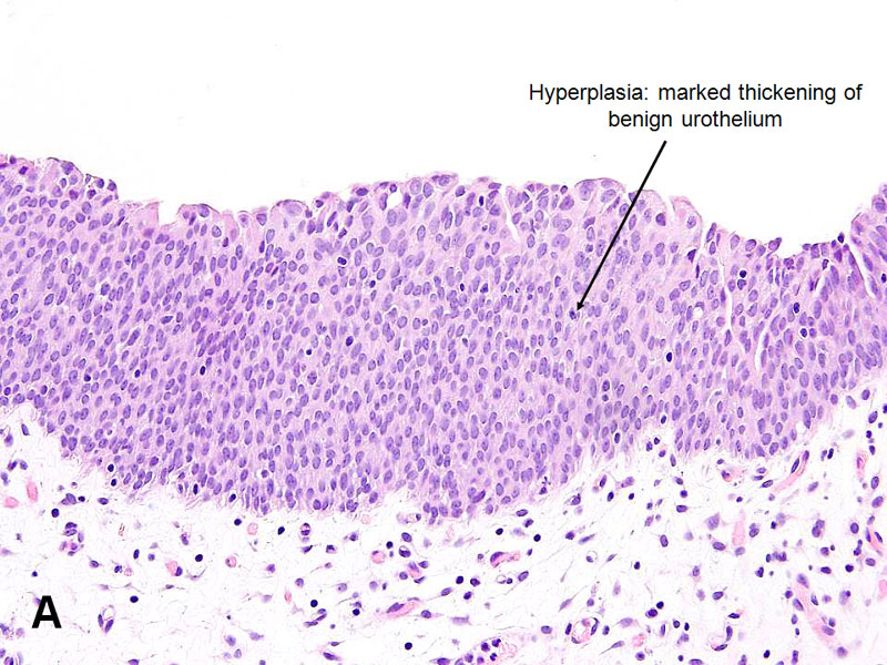 papillary urothelial hyperplasia pathology outlines)