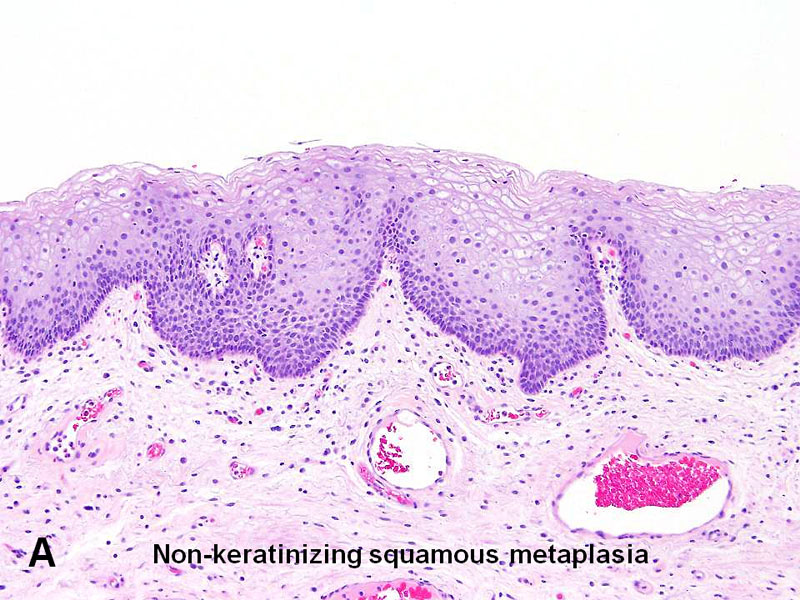 squamous metaplasia papilloma