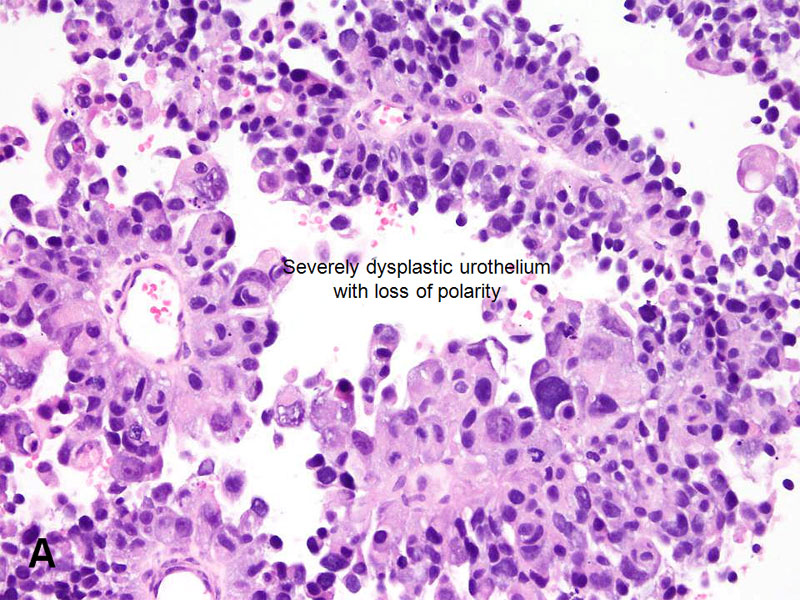Papillary urothelial lesion of low malignant potential - Papillary urothelial malignant