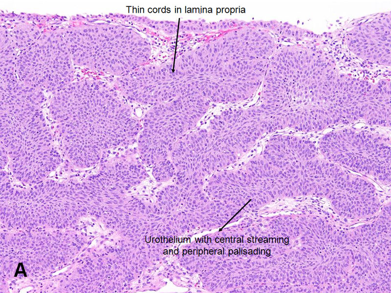 urothelial papilloma treatment papilloma virus sintomi come si contrae