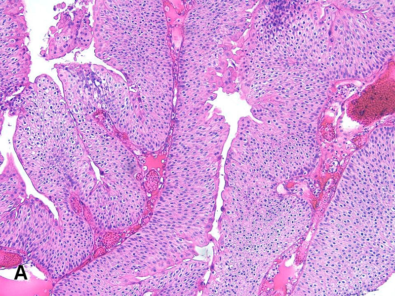 Papillary urothelial tumors
