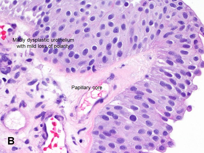 Papillary urothelial disease. Benign papillary urothelial
