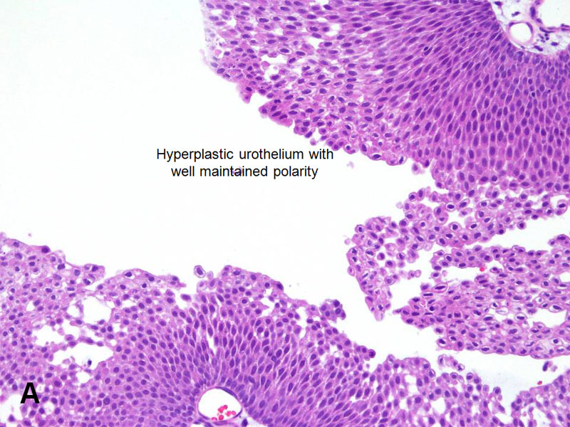 Papillary urothelial hyperplasia