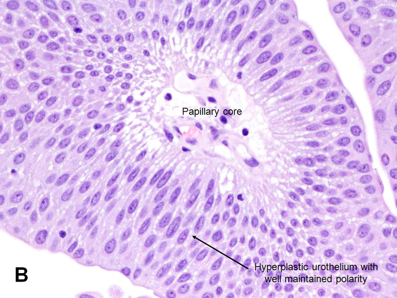 papilláris urothelialis neoplazma punlmp)