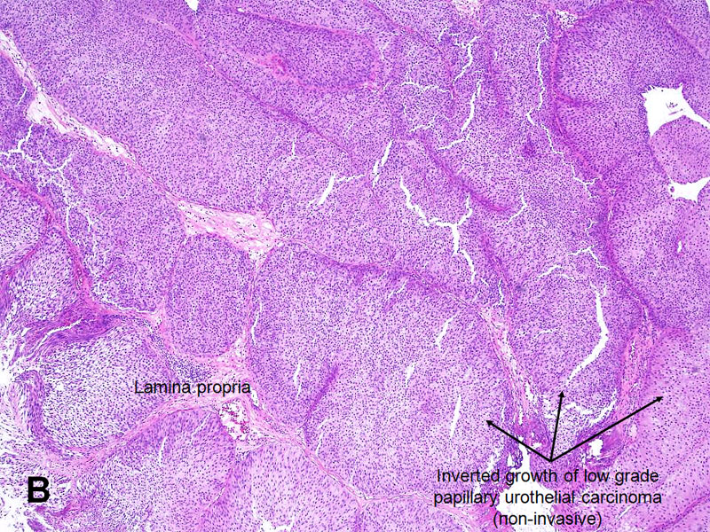 papillary growth of urothelial tumor