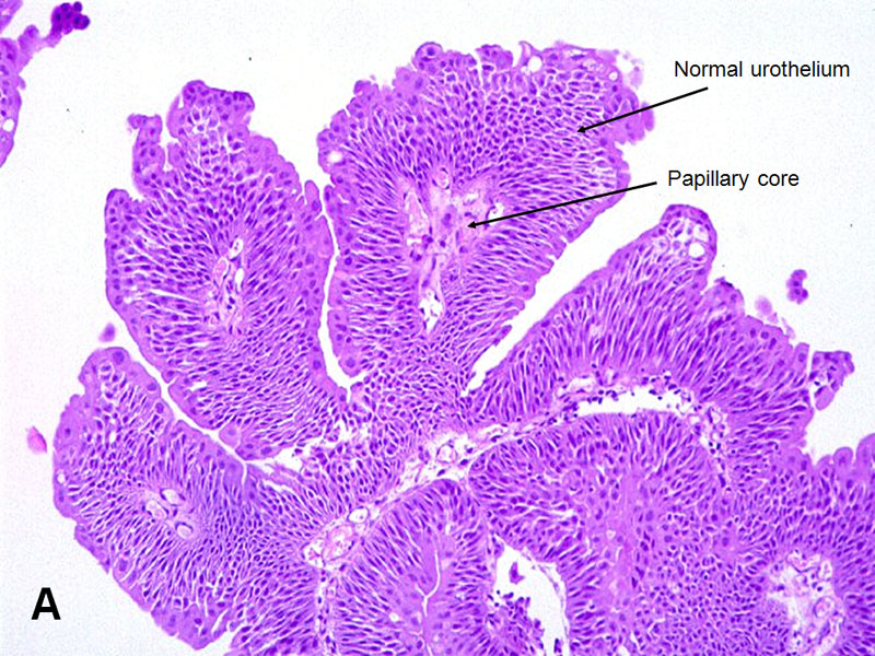 urothelial papilloma histopathology
