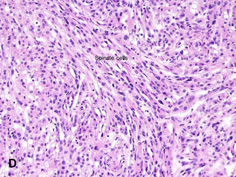 spindle cell sarcoma
