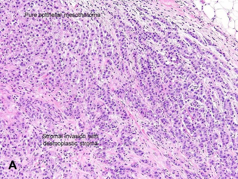 malignant mesothelioma cells