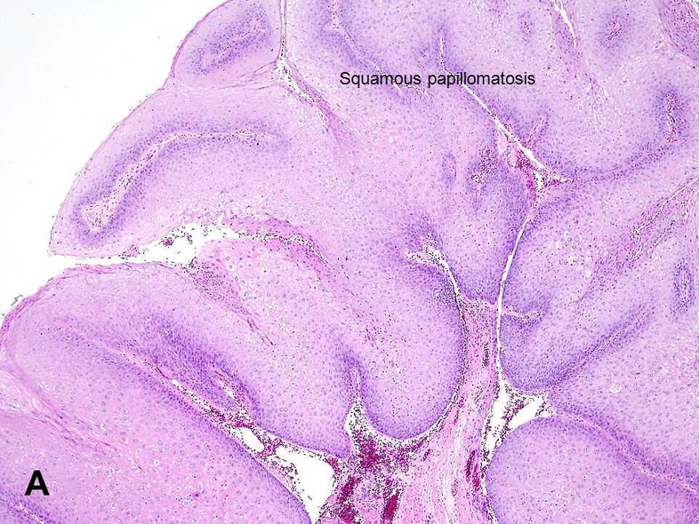 Squamous papilloma vs condiloma