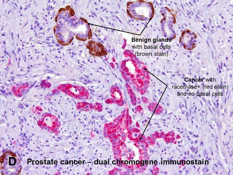histopathology of prostate adenocarcinoma Amelyben az esetekben a prosztatitis művelete van