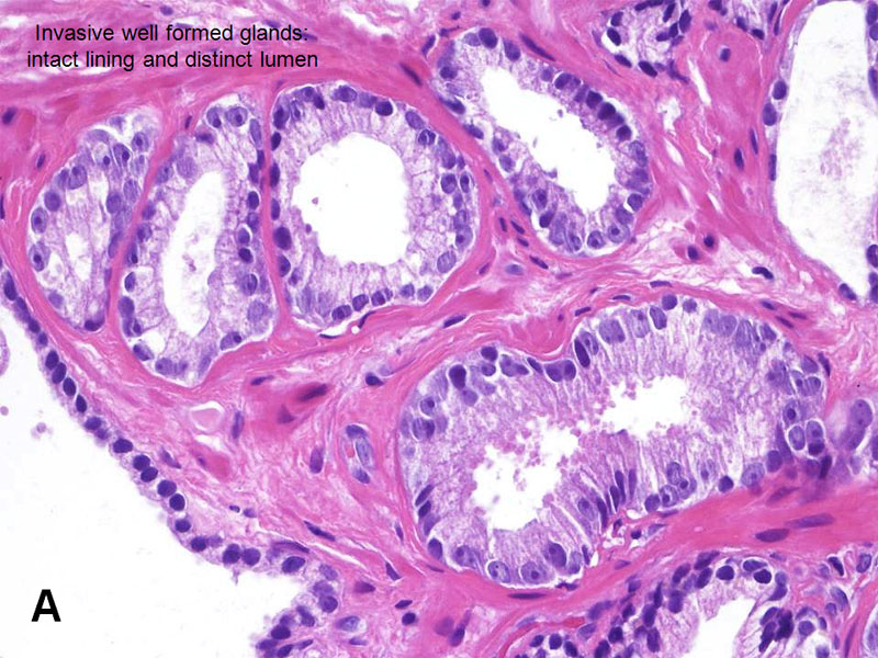 Prostatic Adenocarcinoma: Gleason Pattern 3 - American Urological