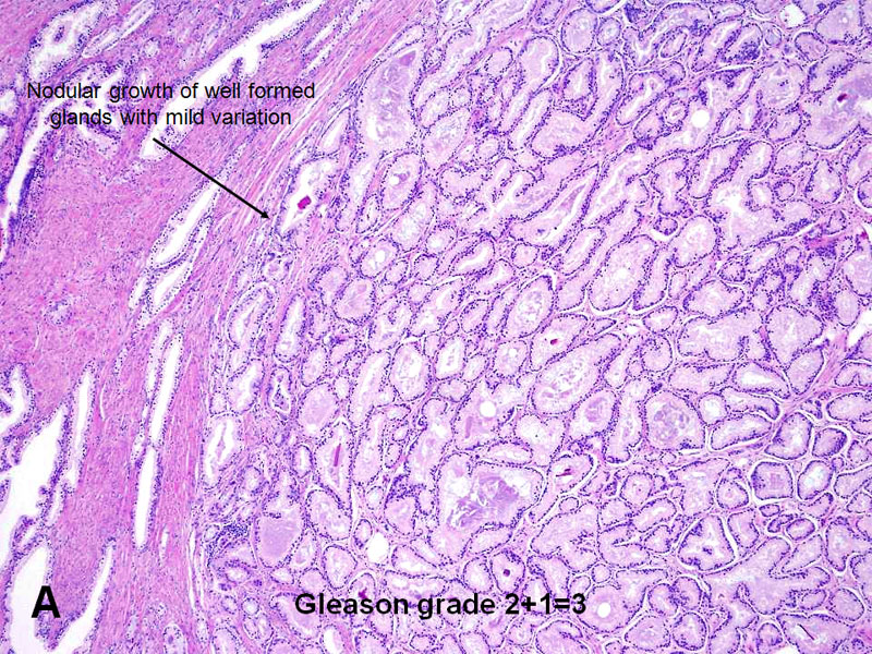histology of prostatic adenocarcinoma hogyan lehet kezelni az ízületi gyulladást és a lábízületet