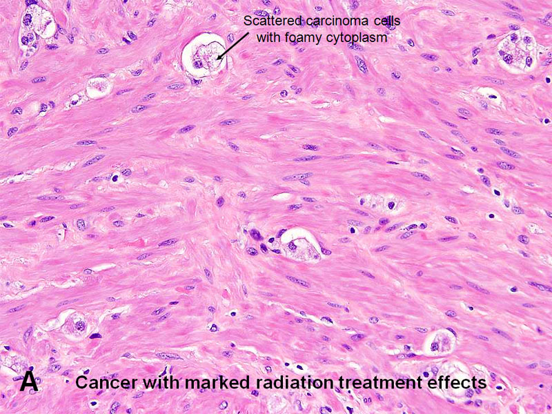 prostate cancer treatment effect histology)