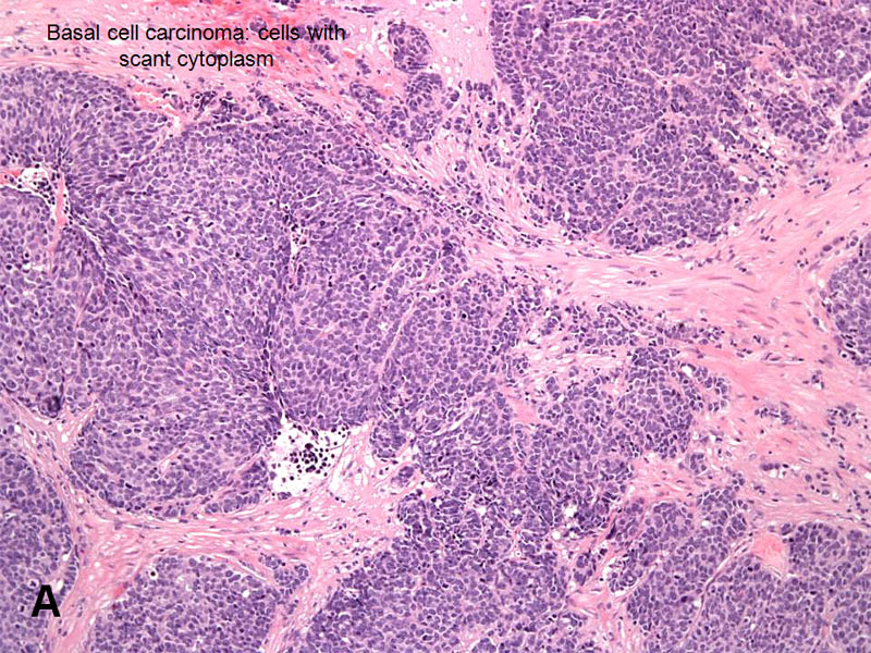 Basal Cell Carcinoma Adenoid Cystic Carcinoma American