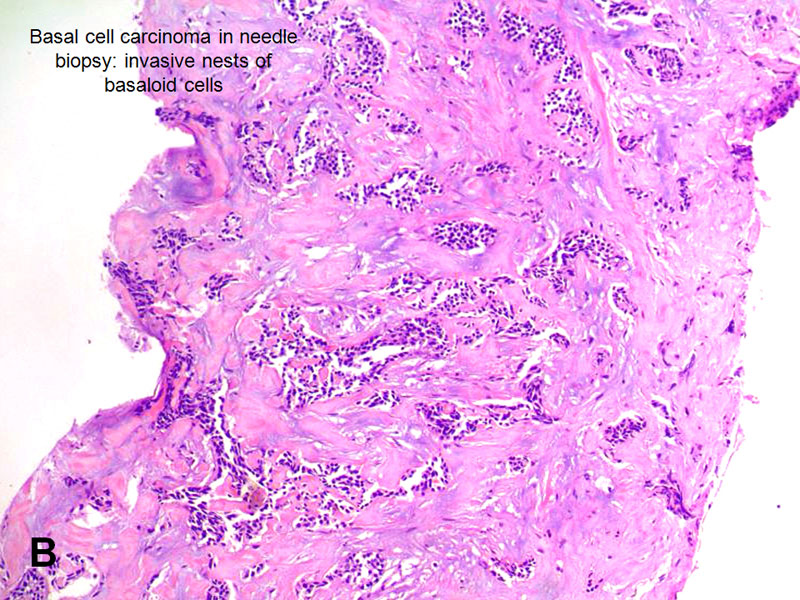 Basal Cell Carcinoma Adenoid Cystic Carcinoma American