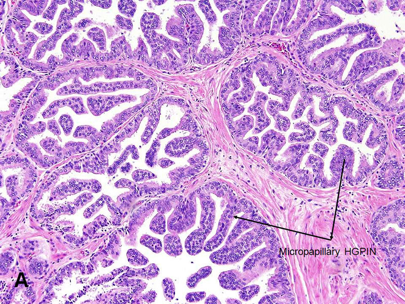 Atypical papillary urothelial hyperplasia,, Papillary urothelial hyperplasia bladder