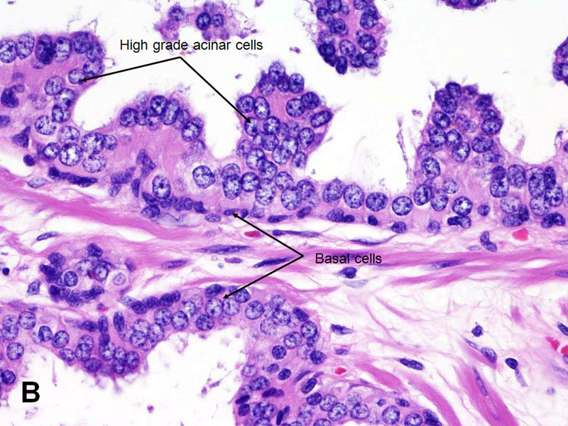 prostate pin pathology outlines psa bioclinica