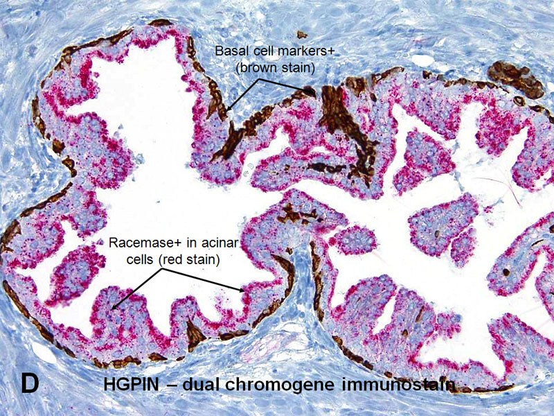prostate high grade pin pathology outlines