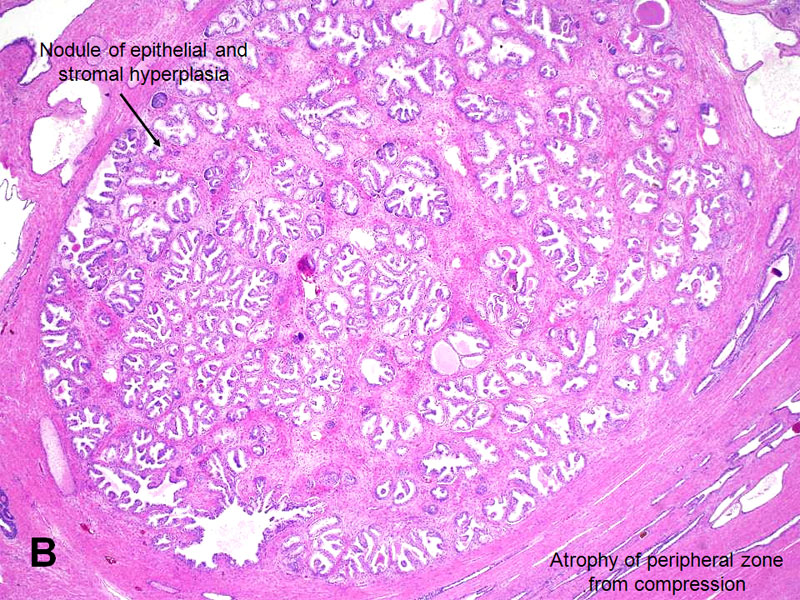 prostatic adenoma pathology outlines