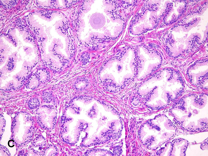 prostate adenocarcinoma pattern 5