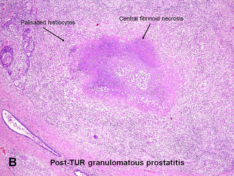 Granulomatous prosztatitis)