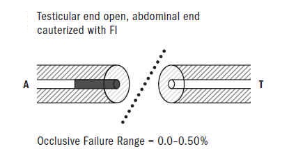 Figure 4: Testicular end open, abdominal end cauterized with FI